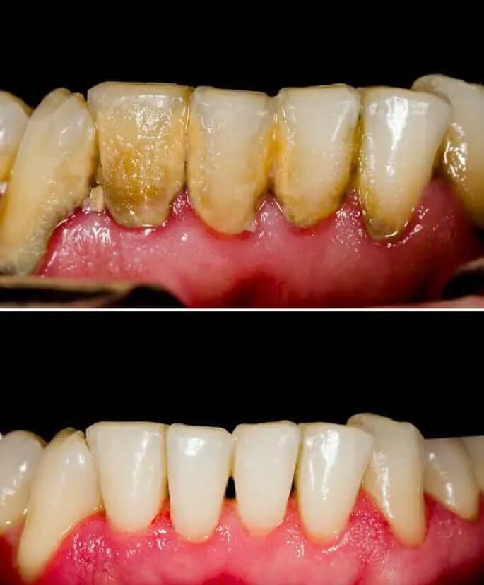 Gum Diseases
